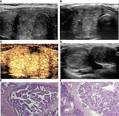 Analysis of the Relevance of the Ultrasonographic Features of Papillary Thyroid Carcinoma and Cervical Lymph Node Metastasis on Conventional and Contrast-Enhanced Ultrasonography